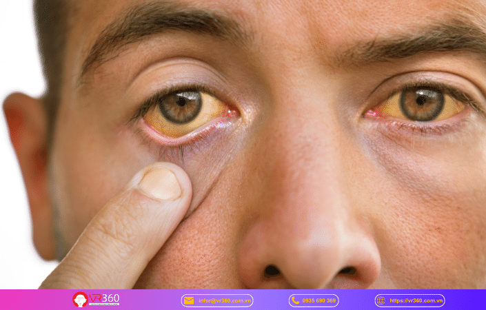 Tác động tiêu cực đến thị giác và sức khỏe mắt: